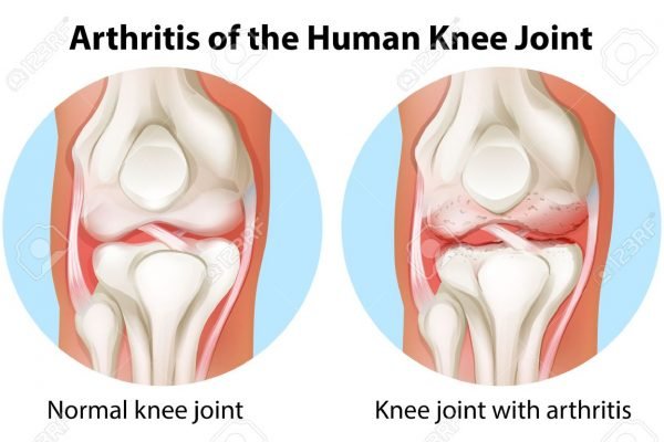 Arthritis Knee Pain - 3 Ways To Improve Knee Joint Mobility